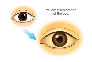 Normal insan gözü için Yellowing değiştirme. Resimde sağlık sorunu ve hastalık belirti hakkında.