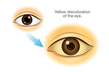 Normal human eye changing to Yellowing. Illustration about symptom from health problem and illness. clipart