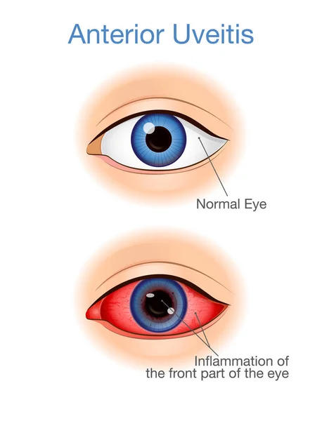 眼睛有前葡萄膜炎和正常的症状比较 眼睛疾病的例证 — 图库矢量图片