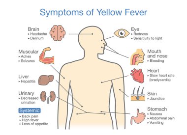 Diagram of Symptoms of Yellow fever patient. Illustration about disease diagnosis.  clipart
