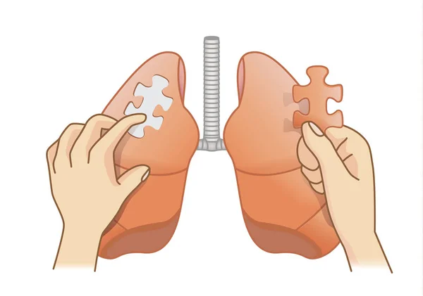 手拿着最后一块拼图加在肺上 危险疾病治疗的医学概念图解 — 图库矢量图片
