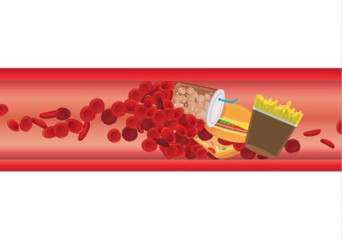 Blood cell in vessel is blocked by high fat foods. illustration about cardiovascular disease from Cholesterol and fatty. clipart