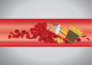 Kan damarı hamburger ve fast food tarafından engellenir. Kolesterol ve yağ tehlike hakkında kavram çizimi.
