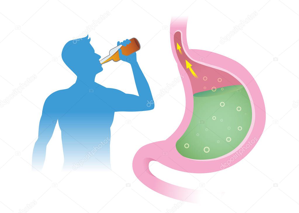 People have acid reflex in stomach from drink alcohol. Illustration about Gastroesophageal reflux disease.
