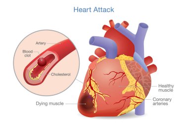 Illustration of Arterial thrombosis is a blood clot that develops to heart attack. Causes and risk factors for health problem. clipart