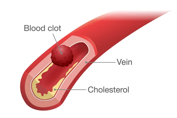 Blood Clot Occurs Vein Illustration Health Problem Medical — Stock Vector