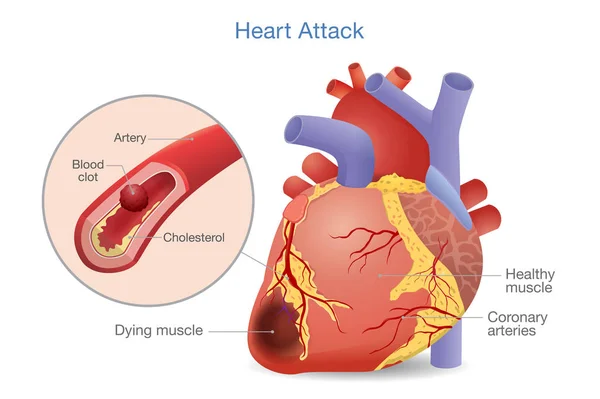 Illustration Arterial Thrombosis Blood Clot Develops Heart Attack Causes Risk — Stock Vector