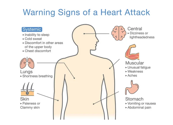 Diagramma Sui Segni Premonitori Infarto Illustrazione Del Diagramma Medico Diagnosticare — Vettoriale Stock