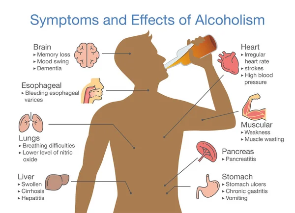Symptoms Effects Alcoholism Patient Illustration Health Problem People Alcohol Addiction — Stock Vector
