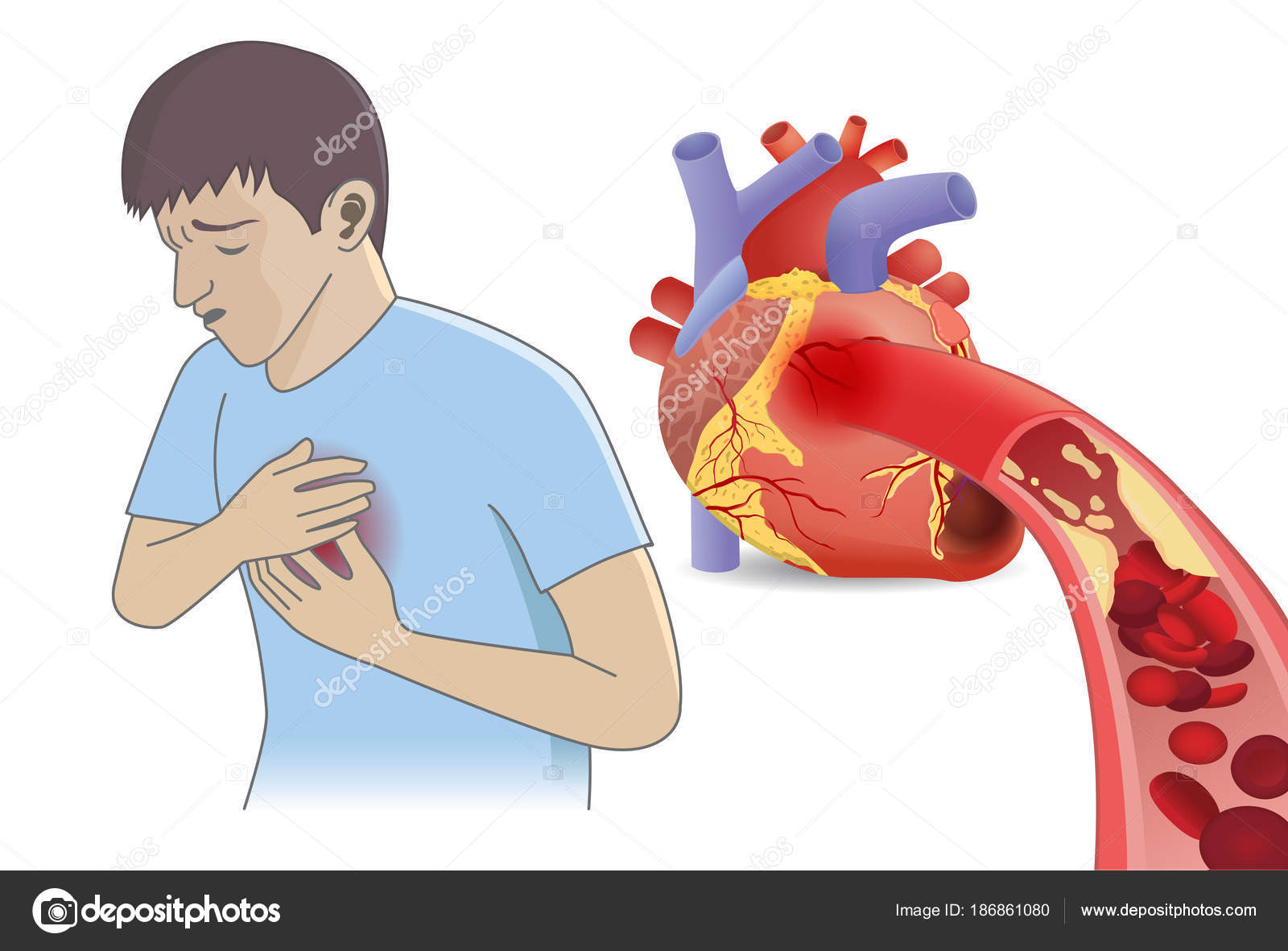 Человека Боль Груди Кровяных Телец Попасть Сердце Помощью Жира Иллюстрация Векторное изображение ©solar22 186861080