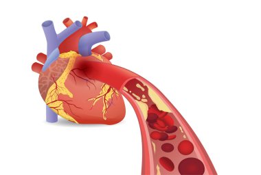 Blood cell can't flow into human heart because clogged arteries by fatty. Illustration about Coronary Artery Disease and medical concept. clipart