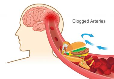 Hamburger ve Pizza ve patates kızartması arter önce beynine tıkanmış kırmızı kan hücre neden engellemek. Resimde hakkında stoke hastalığı.