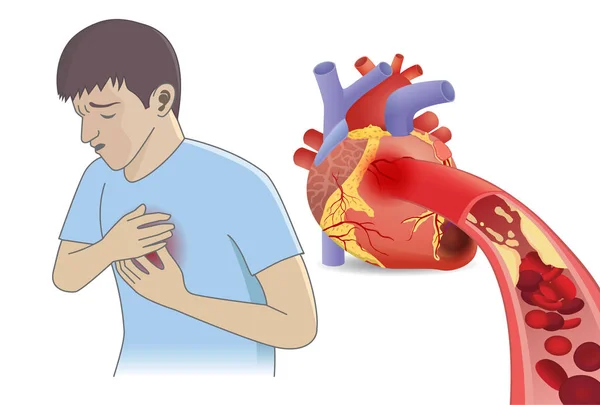 男血液細胞から胸の痛みがある脂肪酸が心臓に流れることができません 冠動脈疾患の医療の概念図 — ストックベクタ