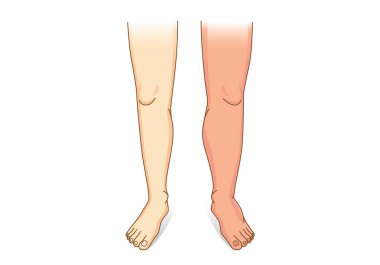 Human Leg swelling in front view. Illustration about the diseases and conditions of fluid gathers in foot and leg. clipart