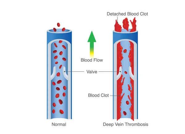 Diagramma Medico Della Trombosi Venosa Profonda Illustrazione Circa Anormalmente Flusso — Vettoriale Stock