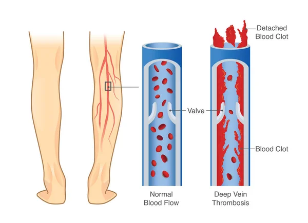 Medical Diagram Deep Vein Thrombosis Leg Area Illustration Abnormally Blood — Stock Vector