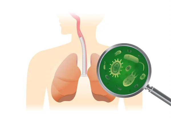 用放大镜在人肺中发现病毒 病毒性肺炎医学例证 — 图库矢量图片