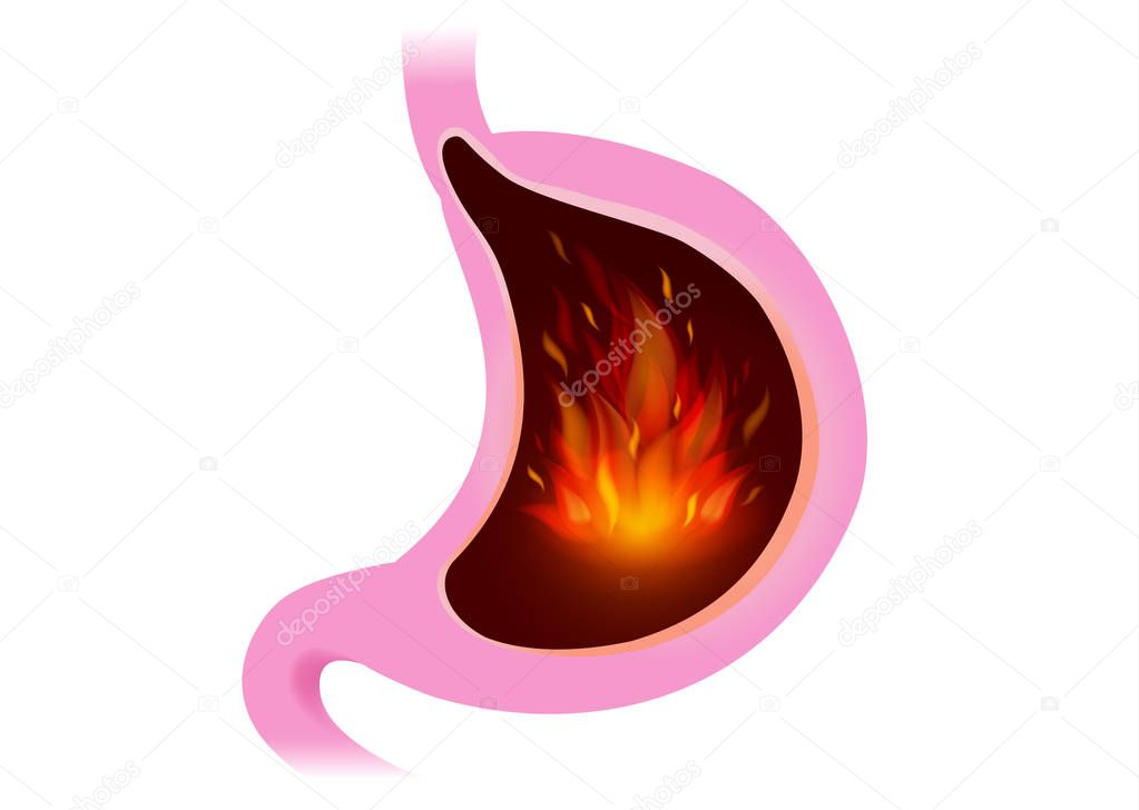 Fire inside stomach isolated on white. Illustration about felling of people with burning sensation from gastritis.