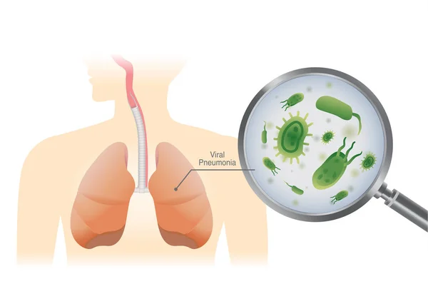 Finding Virus Human Lung Magnifier Medical Illustration Viral Pneumonia — Stock Vector