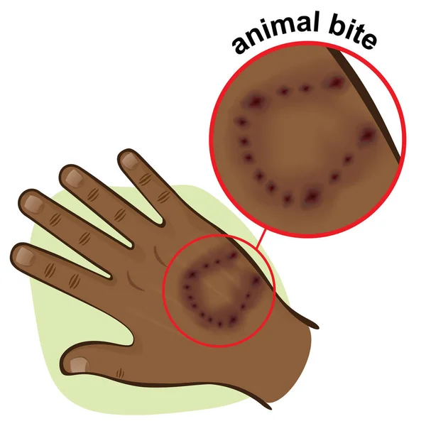 Obrázek je částí lidského těla, ruka s zvířecí kousnutí, afrického původu. Ideální pro první pomoc, lékařská a institucionální materiály — Stockový vektor