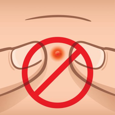 Illustration prohibited anyone squeezing acne with their fingers, Caucasian. Ideal for medical, informative and institutional catalogs clipart
