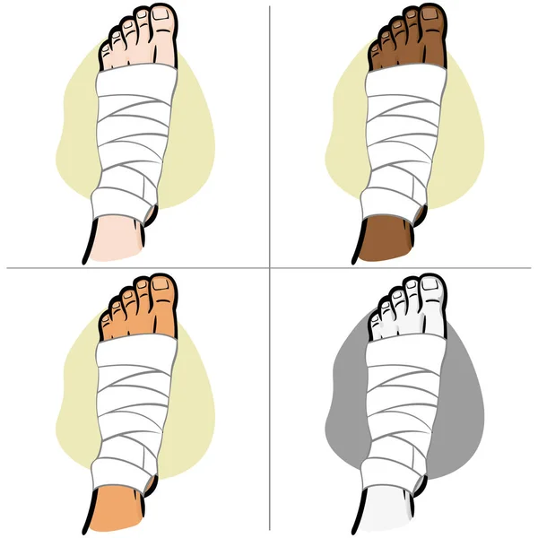 Illustrazione di primo soccorso etnicità persona, piede fasciato, vista dall'alto. Ideale per cataloghi, guide informative e mediche — Vettoriale Stock