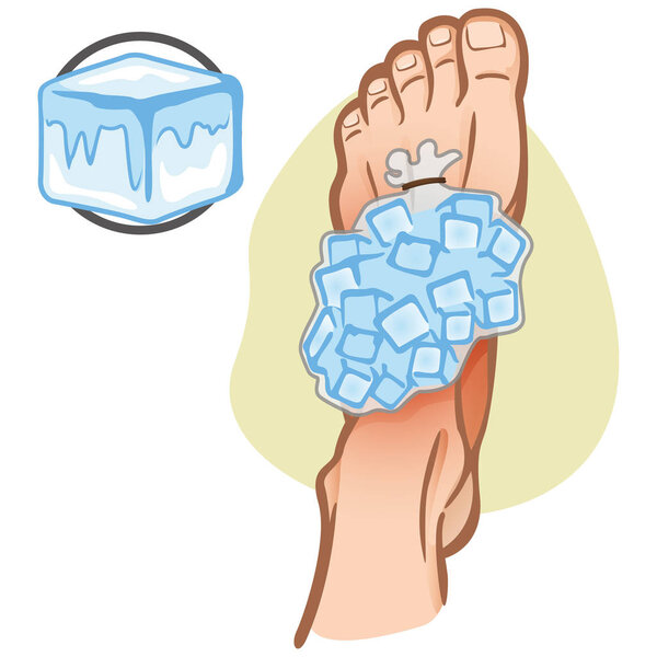 Иллюстрация медвежатника белого, нога с мешком со льдом, вид сверху. Идеально подходит для каталогов, информационных и медицинских гидов
