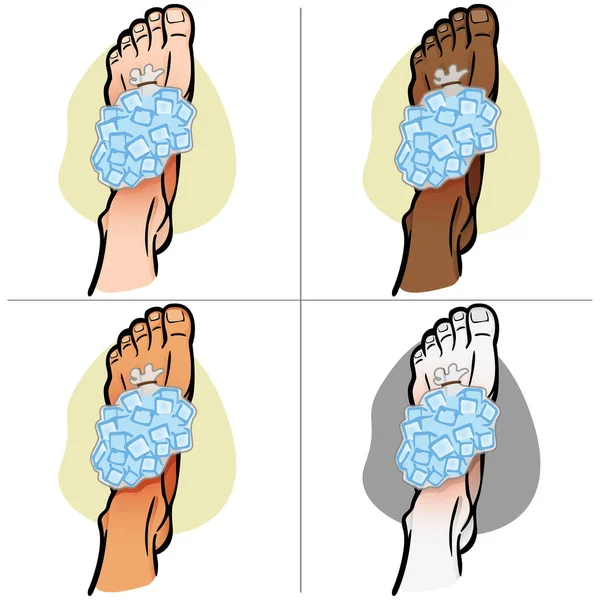 Illustratie van sparren hulp persoon etniciteit, voet met ijs zak, bovenaanzicht. Ideaal voor catalogi, informatie en geneeskunde gidsen — Stockvector