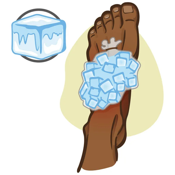 Ilustração de abetos pessoa ajuda afro descida, pé com saco de gelo, vista superior. Ideal para catálogos, informações e guias de medicamentos —  Vetores de Stock