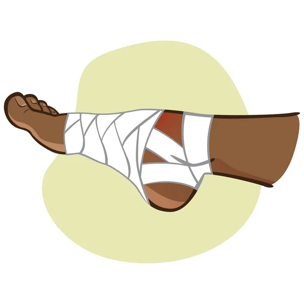 Illustration of first aid afro descendant person, bandaged foot, side view. Ideal for catalogs, information and medicine guides — Stock Vector