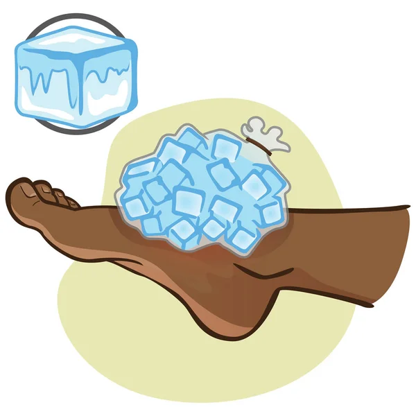 Απεικόνιση του προσώπου πρώτων βοηθειών Αφρο απόγονος, πόδι με σακούλα πάγο, πλευρική θέα. Ιδανικό για καταλόγους, πληροφορίες και ιατρική οδηγοί — Διανυσματικό Αρχείο