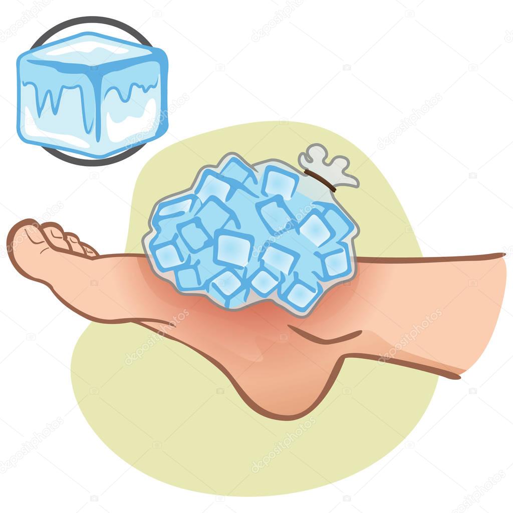 Illustration of first aid person caucasian, foot with ice bag, side view. Ideal for catalogs, information and medicine guides