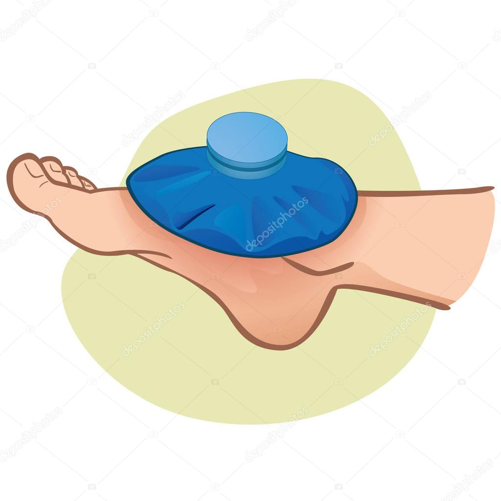 Illustration of first aid person caucasian, foot with thermal bag, side view. Ideal for catalogs, information and medicine guides