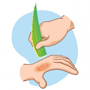 Illustration first aid hands with burn and injury, passing aloe vera, caucasian. Ideal for medical, informative and institutional catalogs clipart