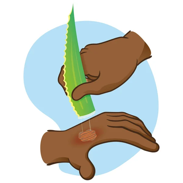Ilustración Manos Primeros Auxilios Con Quemadura Lesión Pasando Aloe Vera — Archivo Imágenes Vectoriales