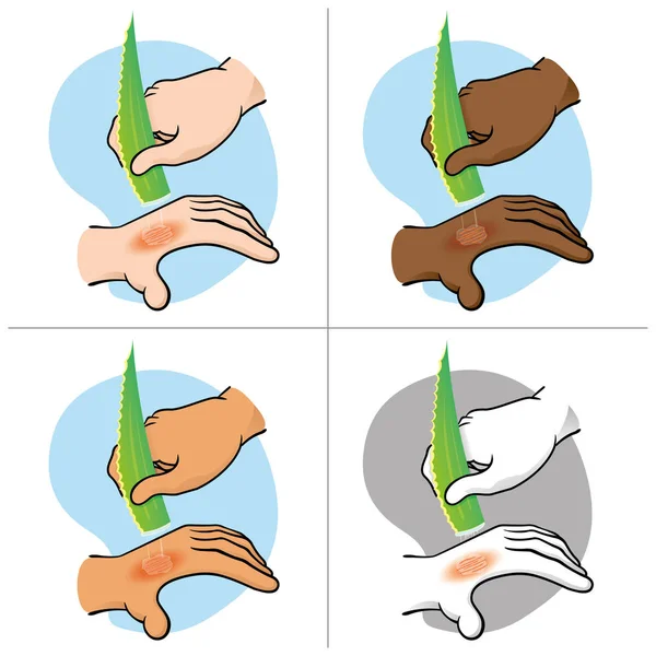 Ilustración Manos Primeros Auxilios Con Quemaduras Lesiones Pasando Aloe Vera — Vector de stock