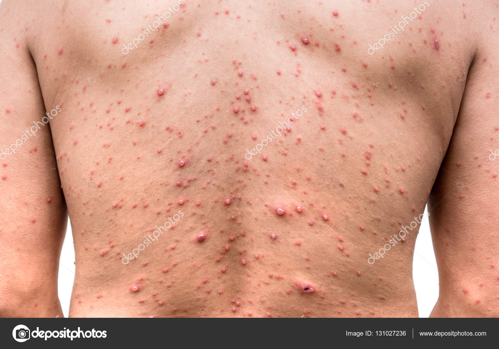 Sintomas Agudos do HIV: Manchas e Rash Cutâneo, image size:1600x1118