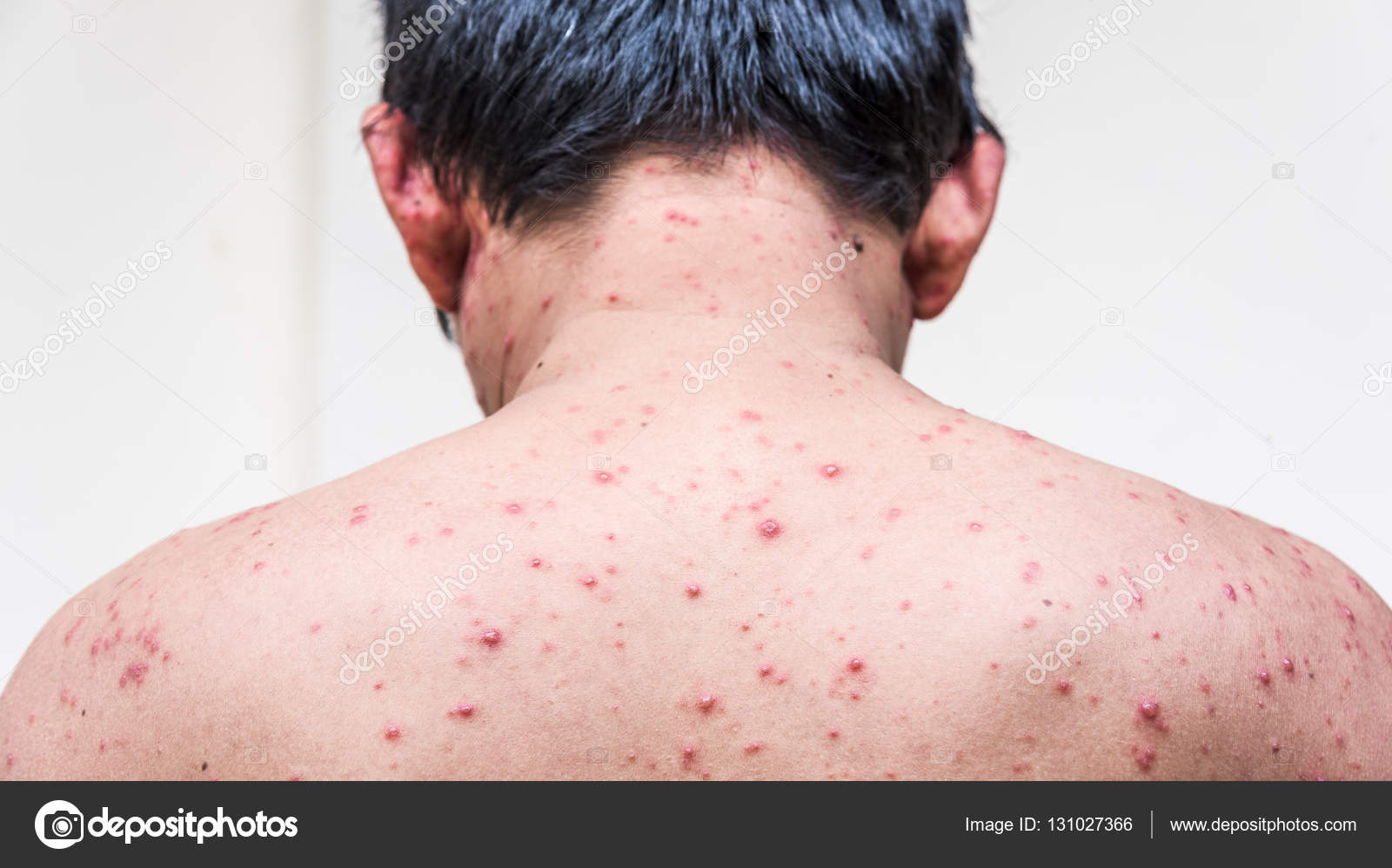 Rash hiv Fotos de Stock, Rash hiv Imagens sem royalties | DepositPhotos, image size:1600x998