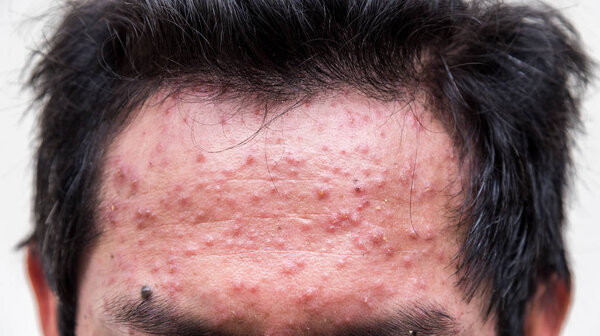   a man who having varicella blister or chickenpox  