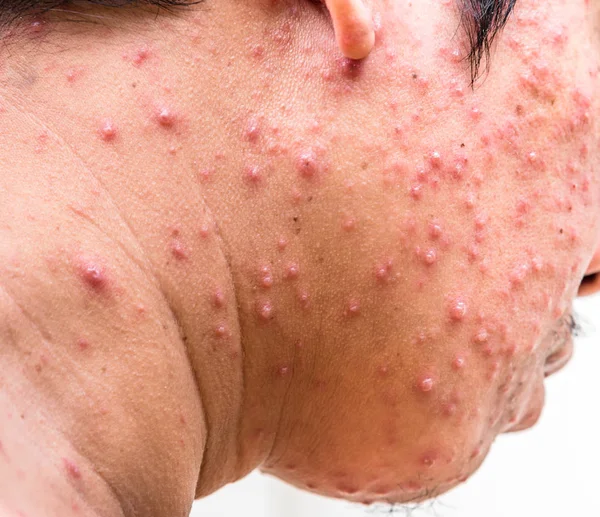 A man who having varicella blister or chickenpox — Stock Photo, Image
