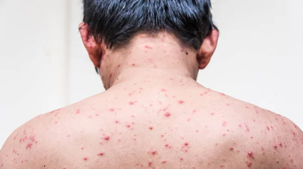 A man who having varicella blister or chickenpox — Stock Photo, Image