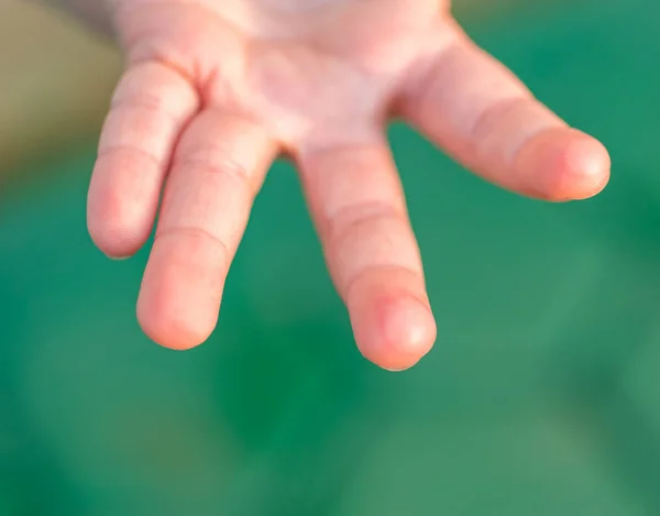 Blister sul dito dei bambini causato da lesioni da acqua calda — Foto Stock