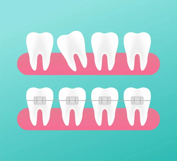 Korrektion af tænder med ortodontiske seler. Stadier af tænder justering. Tandlægeklinikker. Vektorillustration . – Stock-vektor