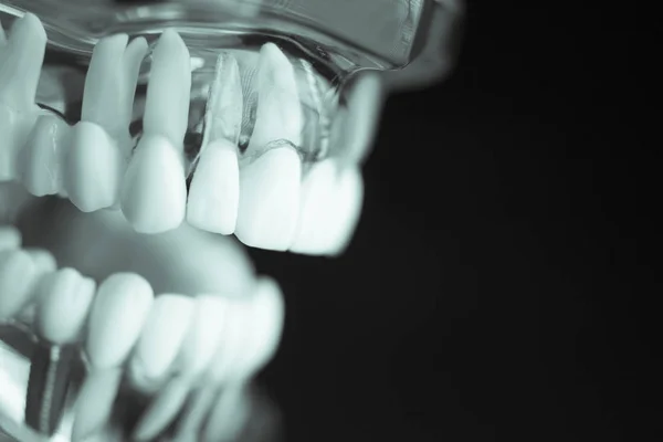Proteza dla studentów stomatologii — Zdjęcie stockowe