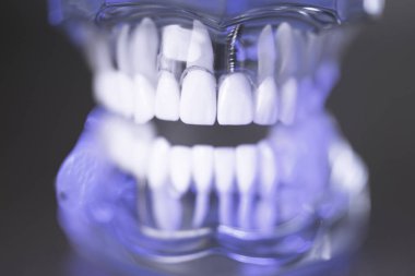 Takma diş diş hekimliği öğrencileri için