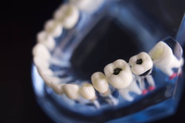 Takma diş diş hekimliği öğrencileri için