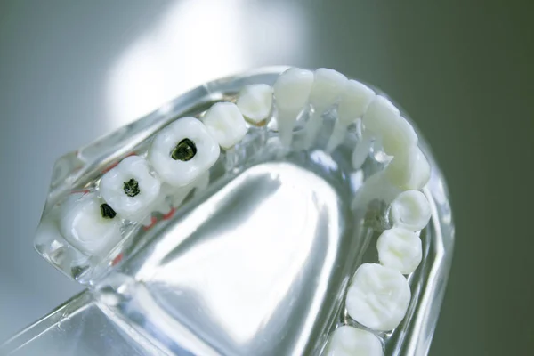 Prótesis dental para estudiantes transparente — Foto de Stock
