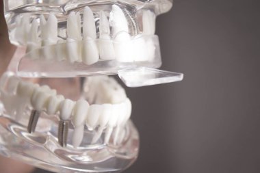 Takma diş üzerinde yerleştirilen silikon kalıplar