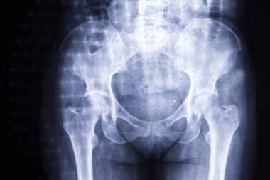 Kadın alt beden Xray