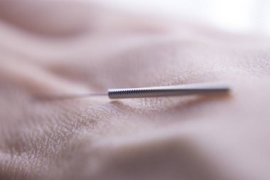 Akupunktur iğnesi. Alternatif Tıp